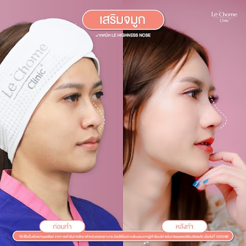 เสริมจมูกใหม่