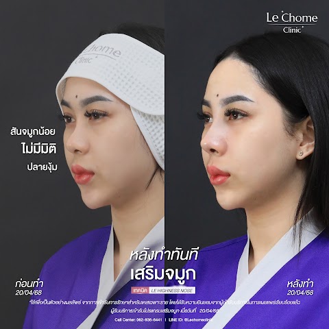 เสริมจมูกใหม่