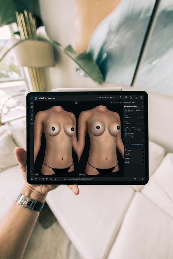 Tenir la main une tablette affichant l’interface de l’application Crisalix avec une simulation mammaire en 3D.
