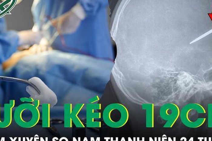 Cứu nam thanh niên 24 tuổi bị lưỡi kéo dài 19 cm đâm xuyên sọ não - Báo Sức Khỏe &amp; Đời Sống