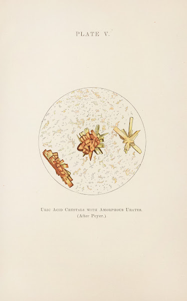 Plate V Uric Acid Crystals with Amorphous Urates 1898