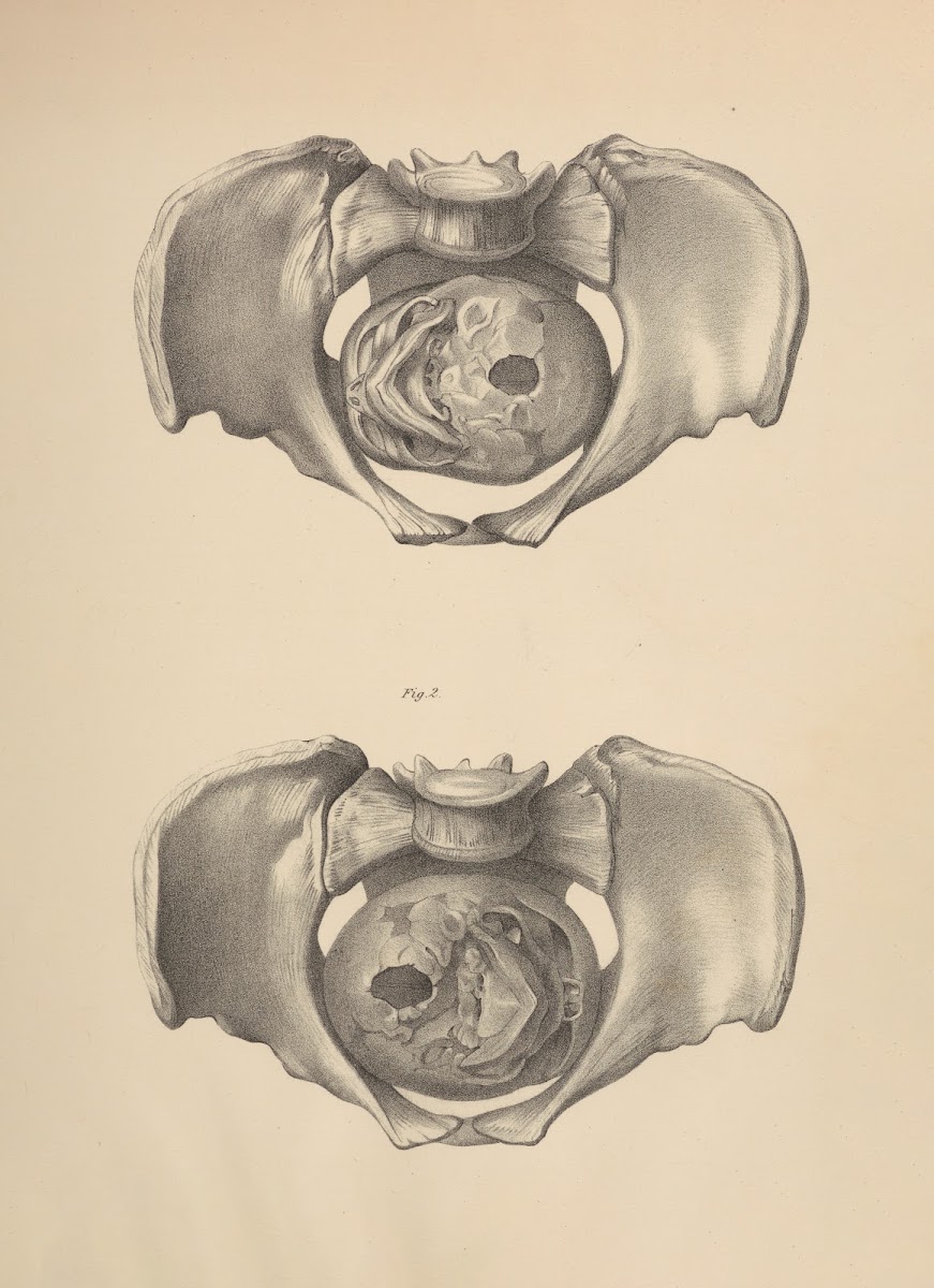 Relations of the Fœtal Head with the Superior Strait in two of the Direct Positi