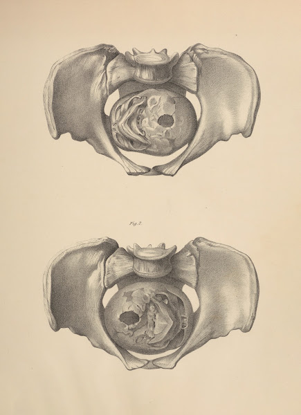 Relations of the Fœtal Head with the Superior Strait in two of the Direct Positi