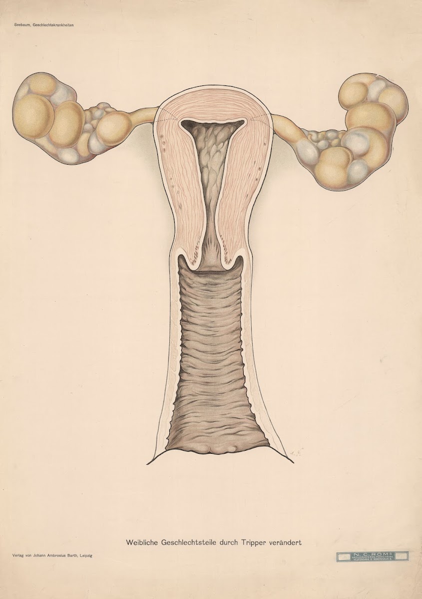 Female reproductive organs altered by gonorrhea 1900