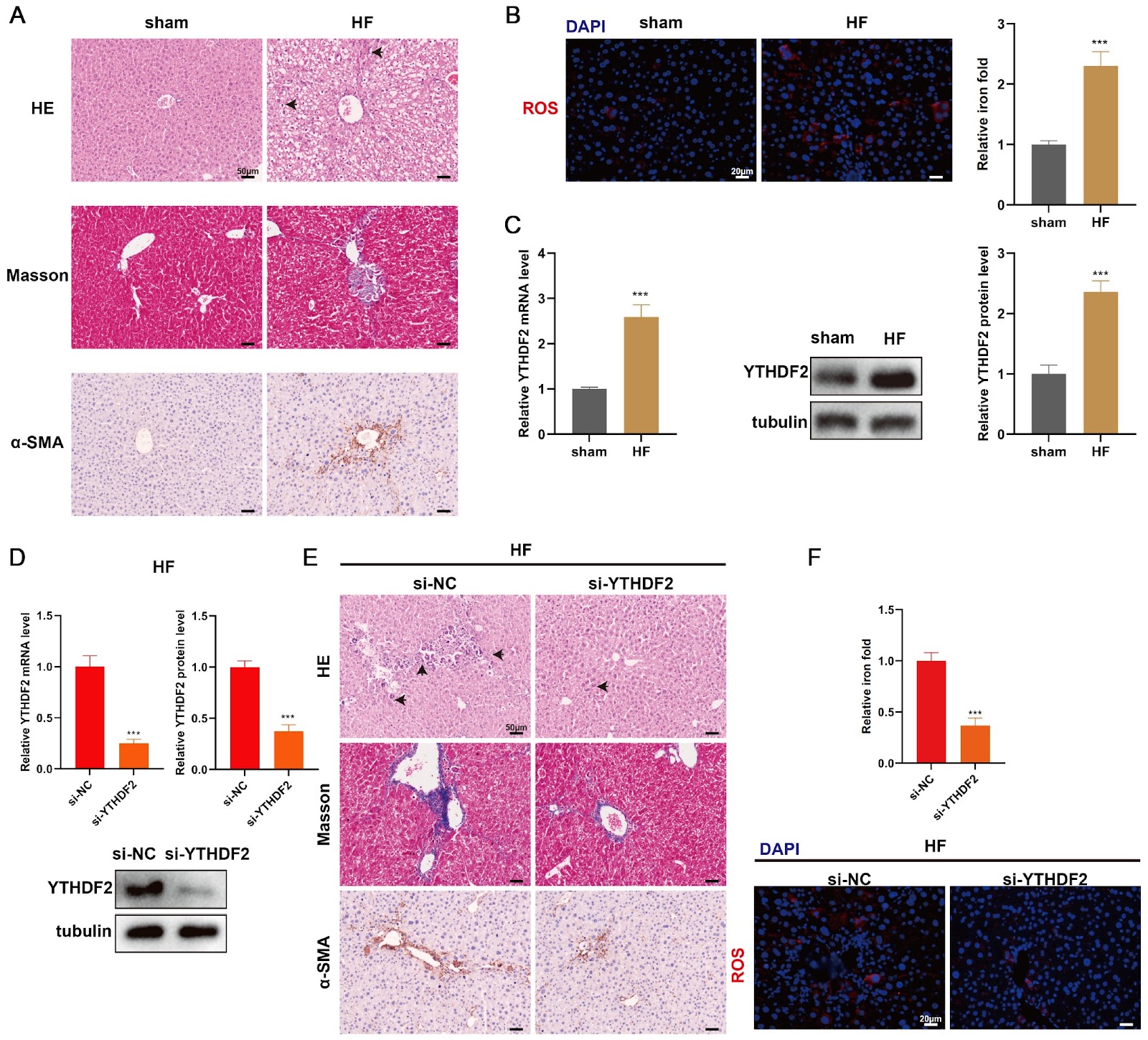 YTHDF2 influences hepatic fibrosis by regulating ferroptosis in hepatic stellate cells by mediating the expression of ACSL4 in an m6A-dependent manner