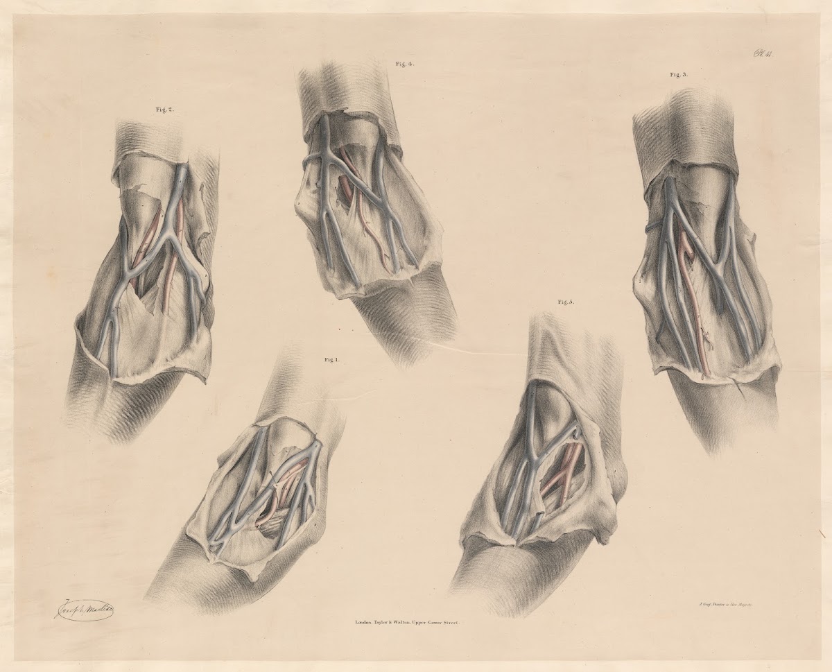 Views of the Superficial veins in front of the elbow joint in connexion with sev