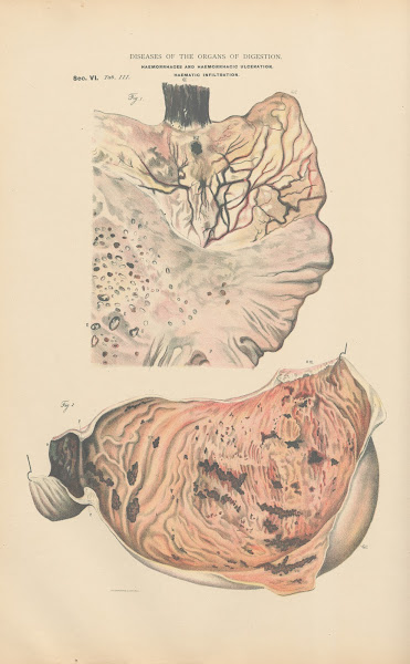 Haemorrhage And Haemorrhagic Infiltration Into The Mucous Membranes Of The Stoma