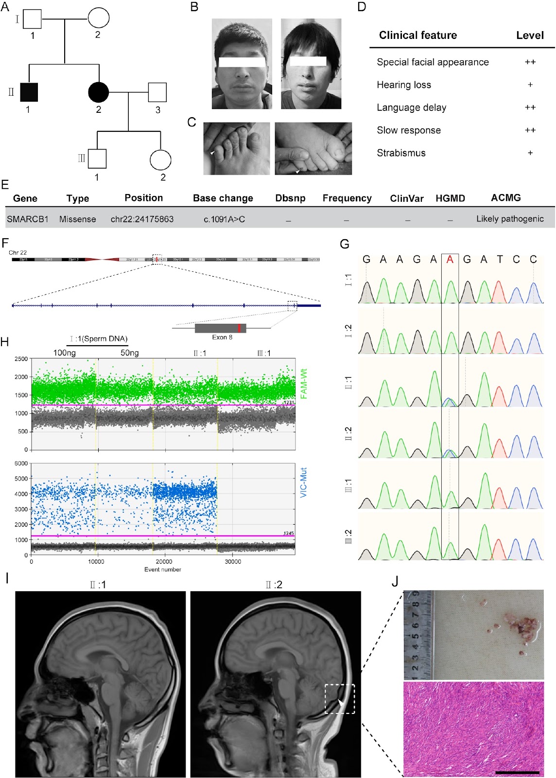 A novel mutation in SMARCB1 associated with adult Coffin-Siris syndrome and meningioma