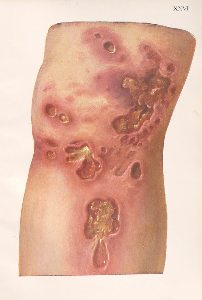 Venereal Diseases  Syphilis Pl26 1908
