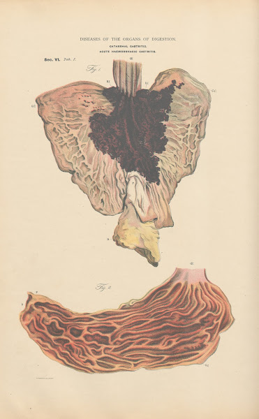 Catarrhal And Haemorrhagic Inflammation Of The Stomach Peracute Gastritis 1888
