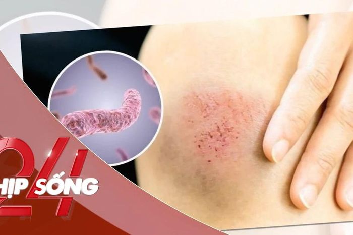 NHỊP SỐNG 24: 23 người ở Thái Lan tử vong do bệnh 'sốt đất' , Bộ Y tế Việt Nam ra khuyến cáo - Báo Tiền Phong