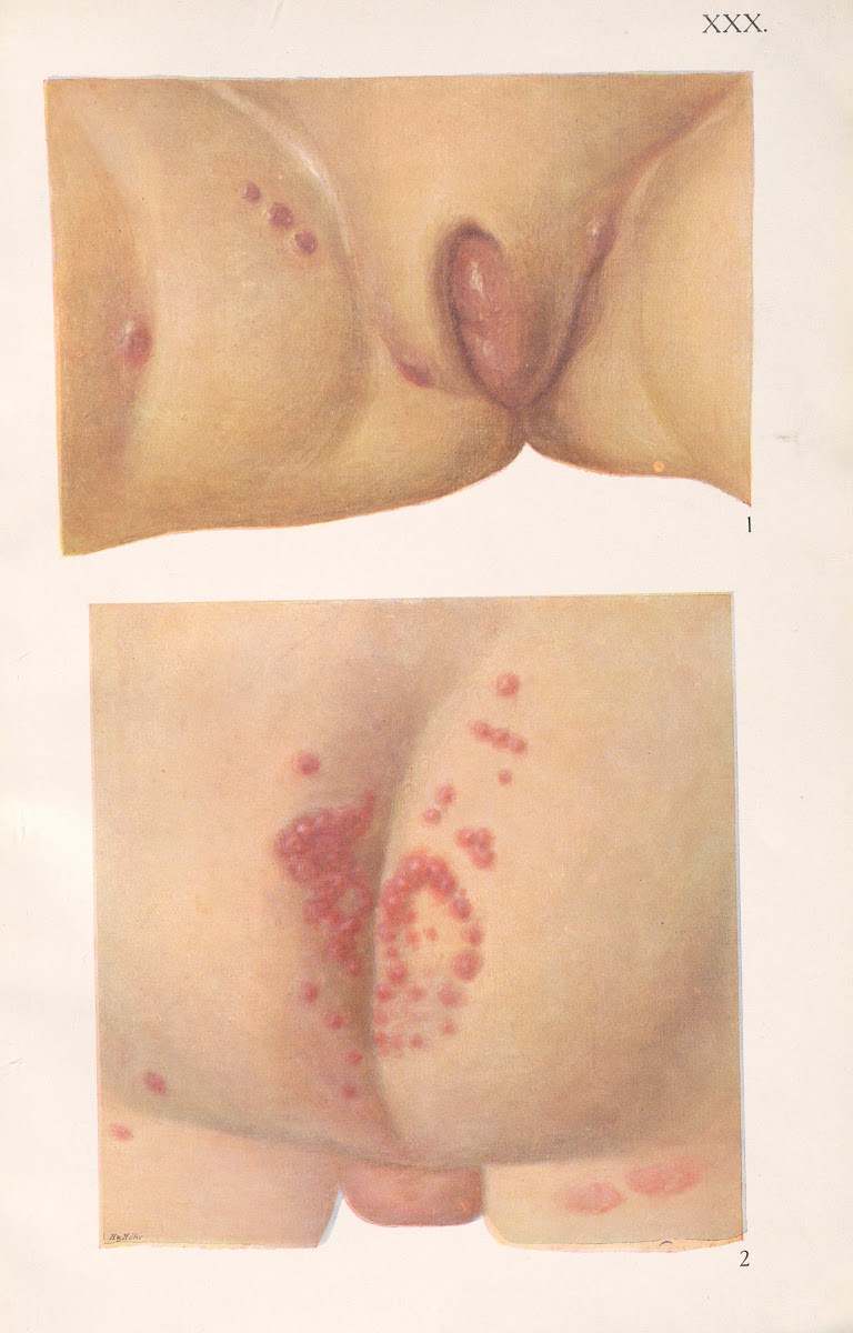Venereal diseases  Syphilis Pl30 1908