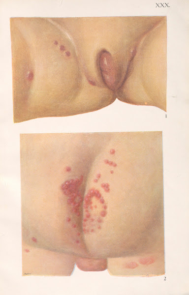 Venereal diseases  Syphilis Pl30 1908