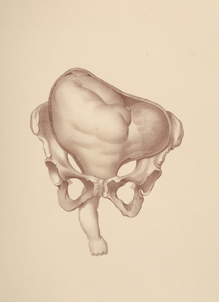 Artificial LaborPresentations of the Shoulders and Arms 1885