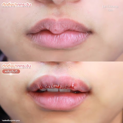 ตกแต่งริมฝีปาก