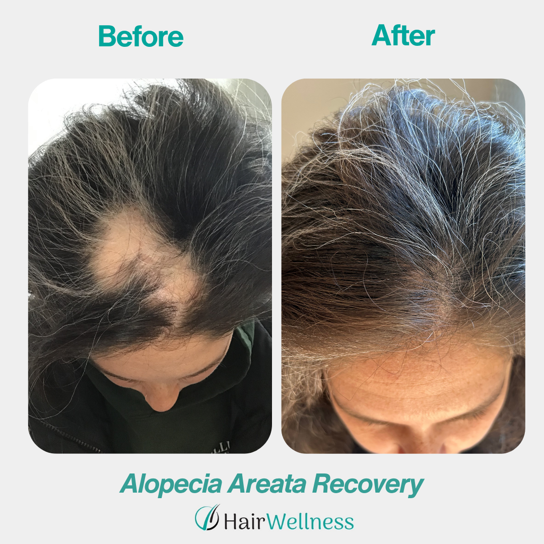 Alopecia areata recovery treatment result