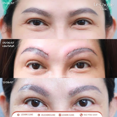 ตา 2 ชั้น