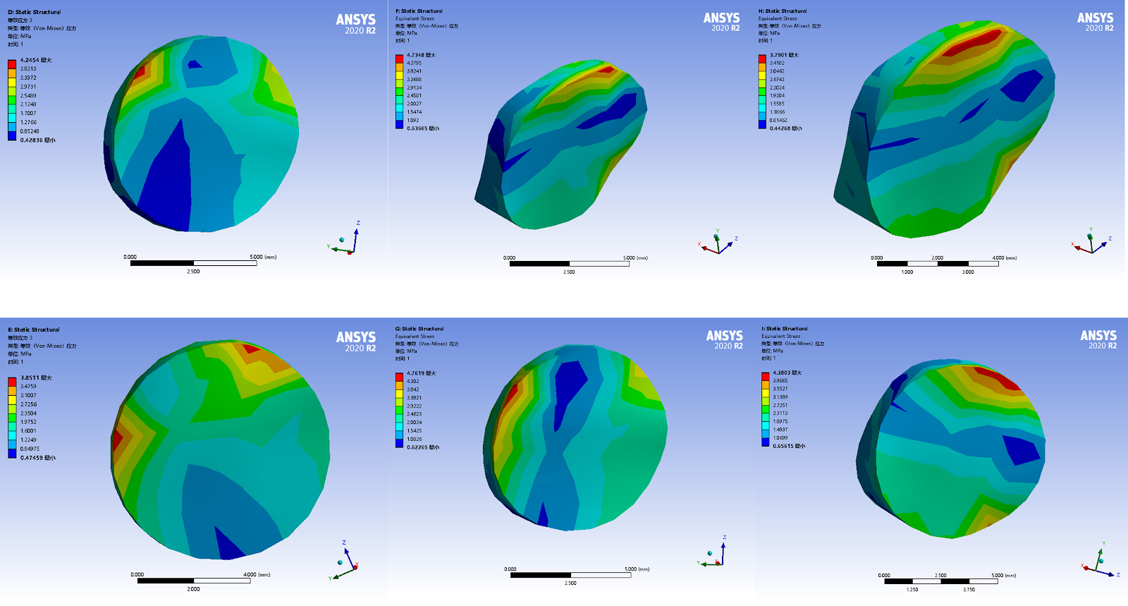 Finite element analysis of two fixation methods for Salter-Harris type II distal radius epiphyseal fracture in children