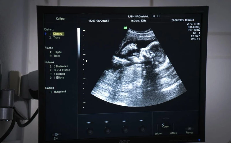 Illustrative image of an obstetric ultrasound monitor (not from the viral video)