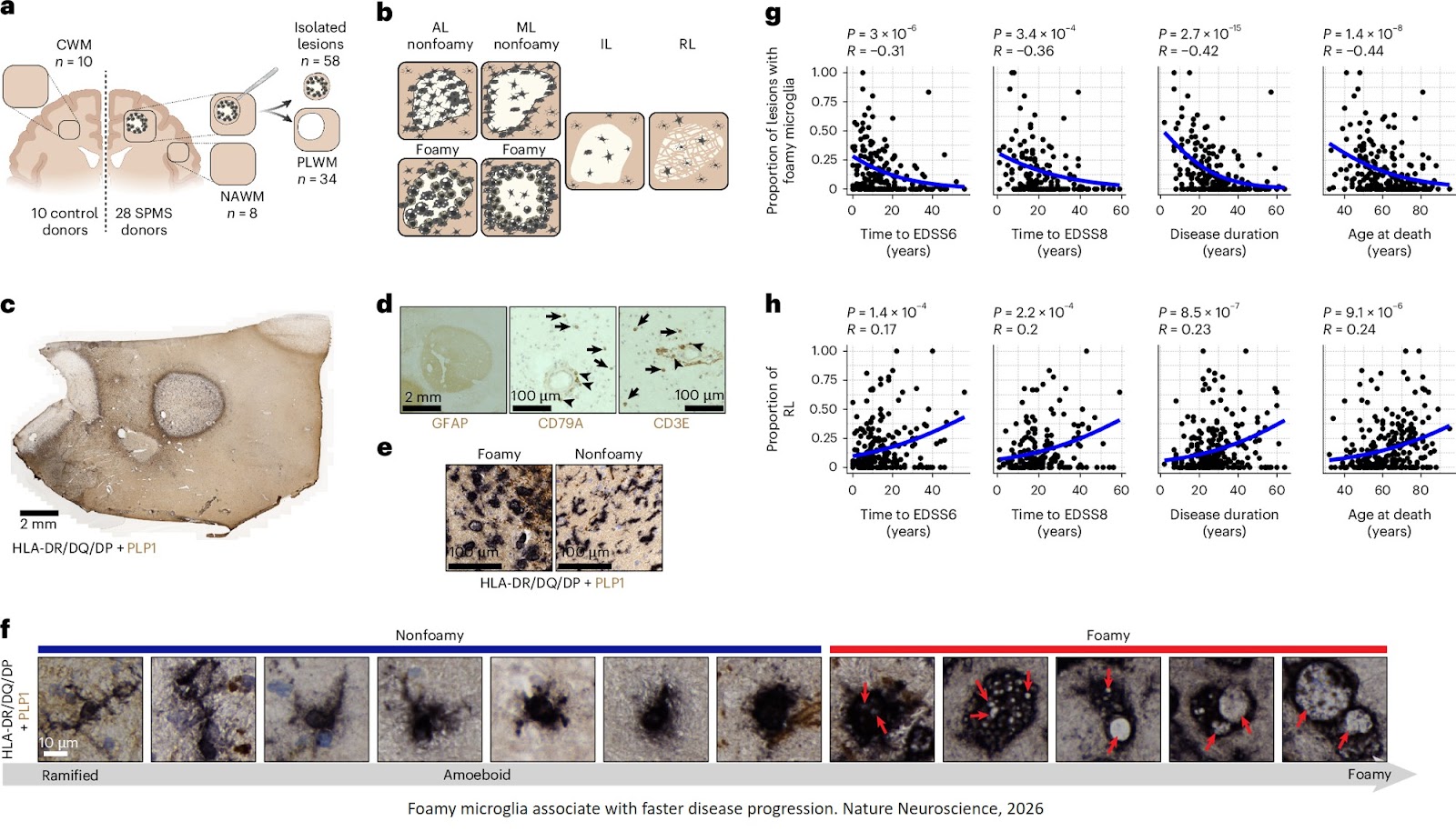 Foamy microglia link oxylipins to disease progression in multiple sclerosis
