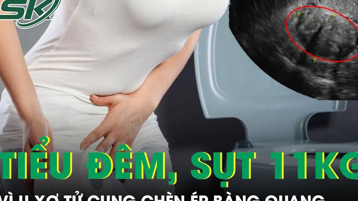 Người phụ nữ tiểu đêm liên tục, sụt 11kg vì khối u xơ tử cung chèn ép bàng quang - Báo Sức Khỏe &amp; Đời Sống
