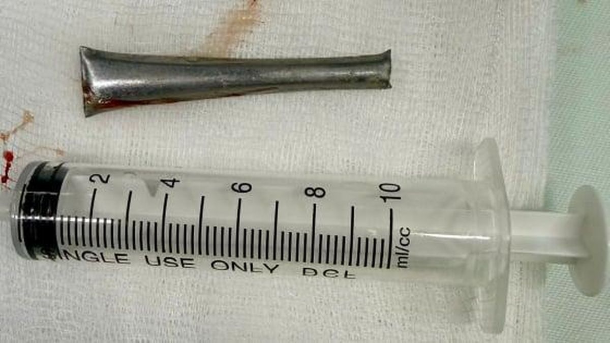 Cán thìa inox 'ẩn náu' trong phế quản người đàn ông - Tạp chí Gia Đình Việt Nam