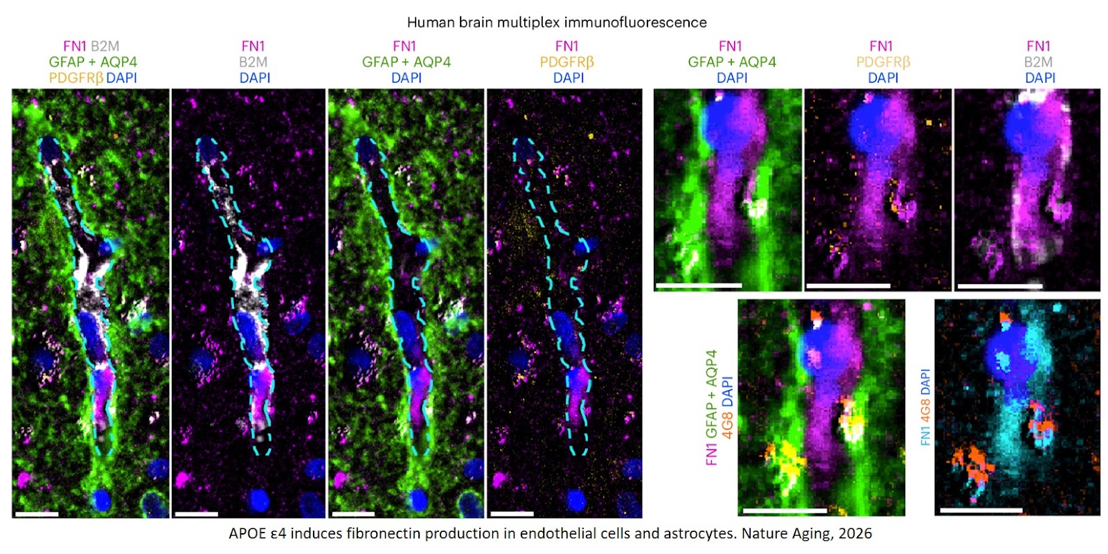 Fibronectin mediates APOE4-driven blood–brain barrier dysfunction in Alzheimer’s disease