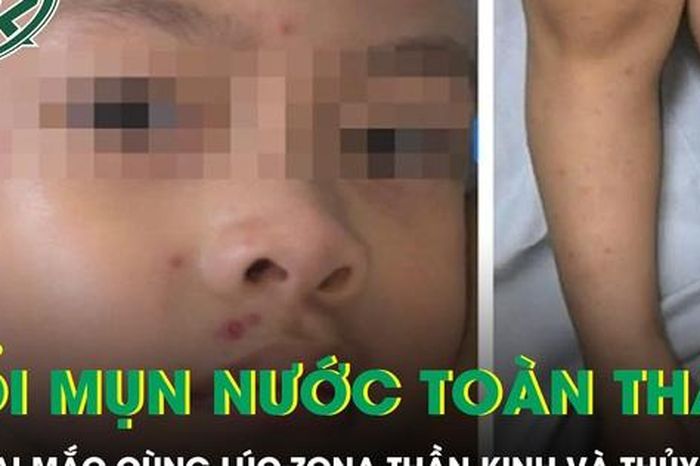 Bé trai 4 tuổi nổi kín mụn nước toàn thân sau khi mắc cùng lúc zona thần kinh và thủy đậu - Báo Sức Khỏe &amp; Đời Sống
