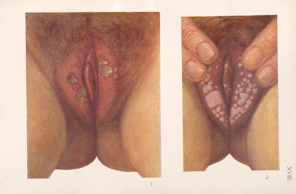 Venereal diseases  Syphilis Pl18 1908