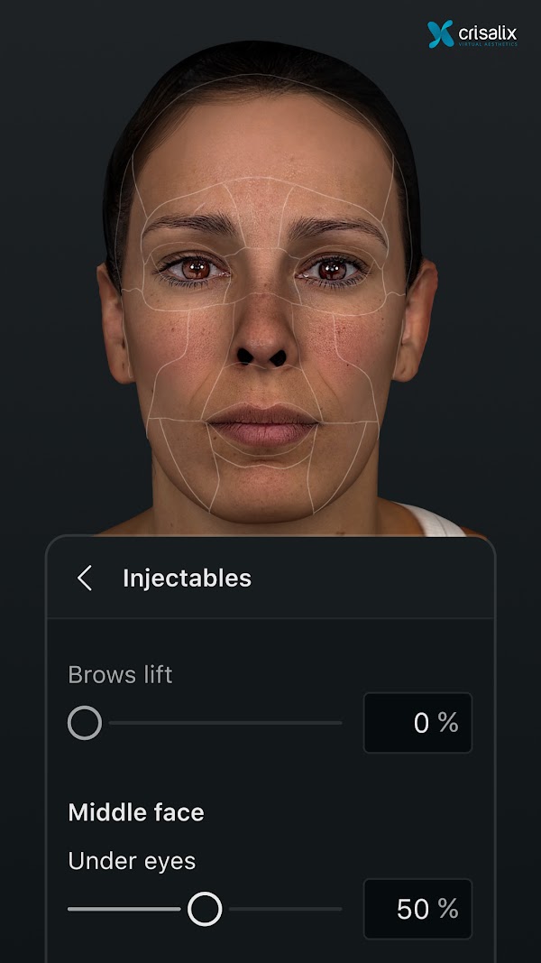 Simulation faciale 3D dans l’application Crisalix avec l’outil de procédure « Injectables » ouvert. 1080px x 1920px.