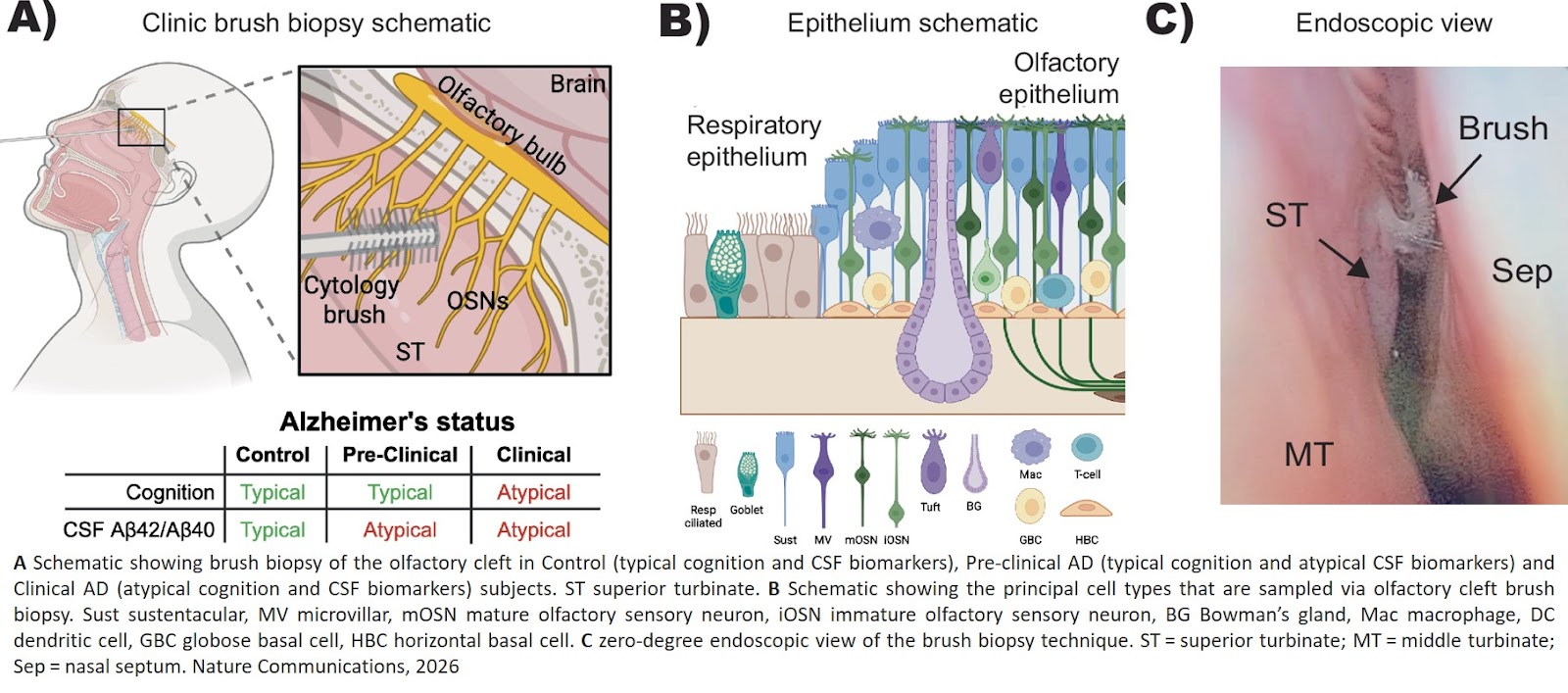 Olfactory cleft biopsy analysis of Alzheimer’s disease pathobiology across disease stages