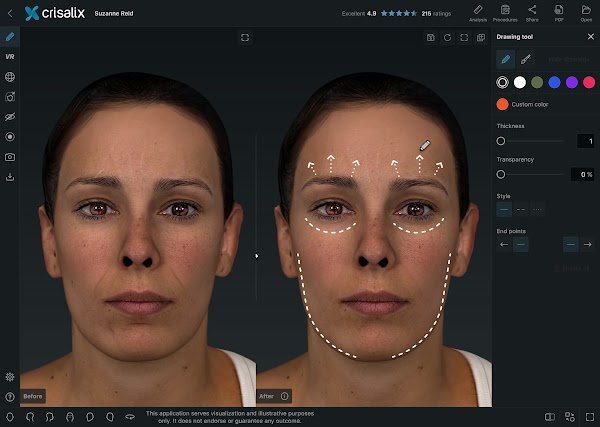 Simulation 3D des visages dans l’application Crisalix avec l’outil « Dessin » ouvert.