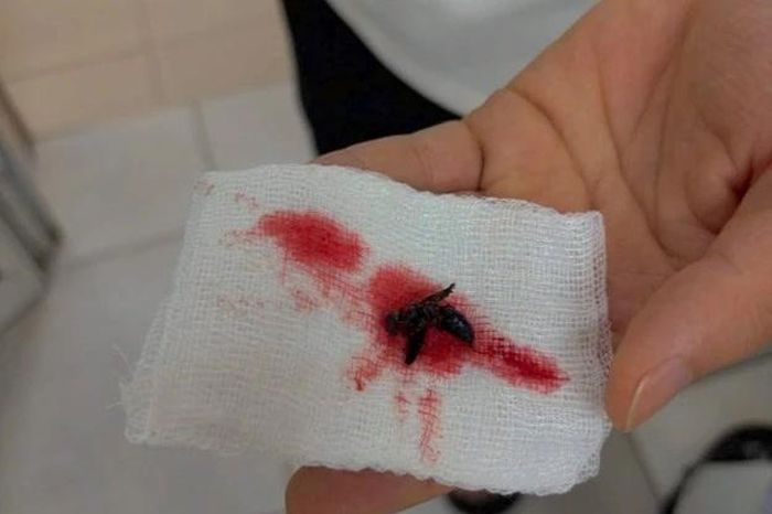 Ong vò vẽ chui sâu vào tai, người đàn ông nhập viện cấp cứu - Báo Tri thức &amp; Cuộc sống