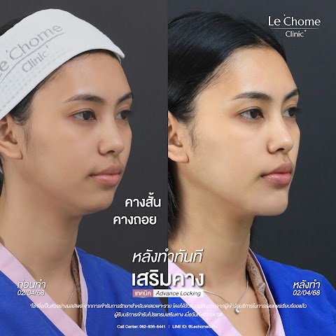 เสริมคาง (ใหม่)