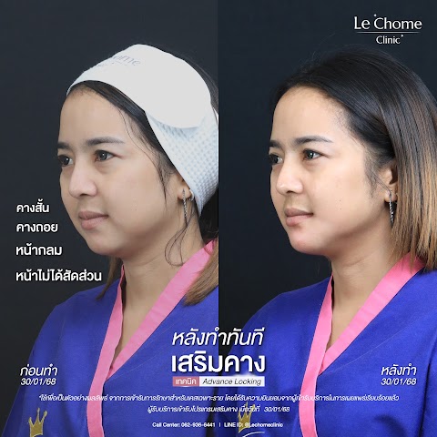 เสริมคาง (ใหม่)
