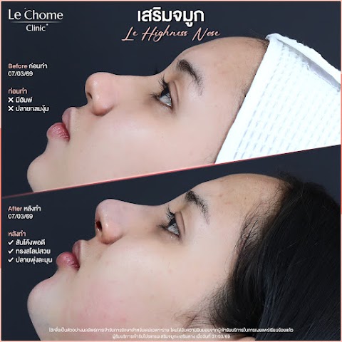 เสริมจมูก