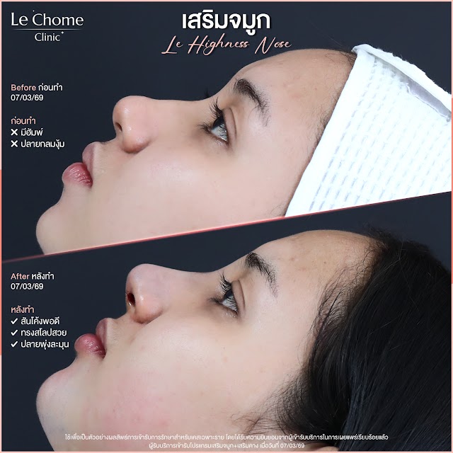 รีวิวเสริมจมูก — เสริมจมูก