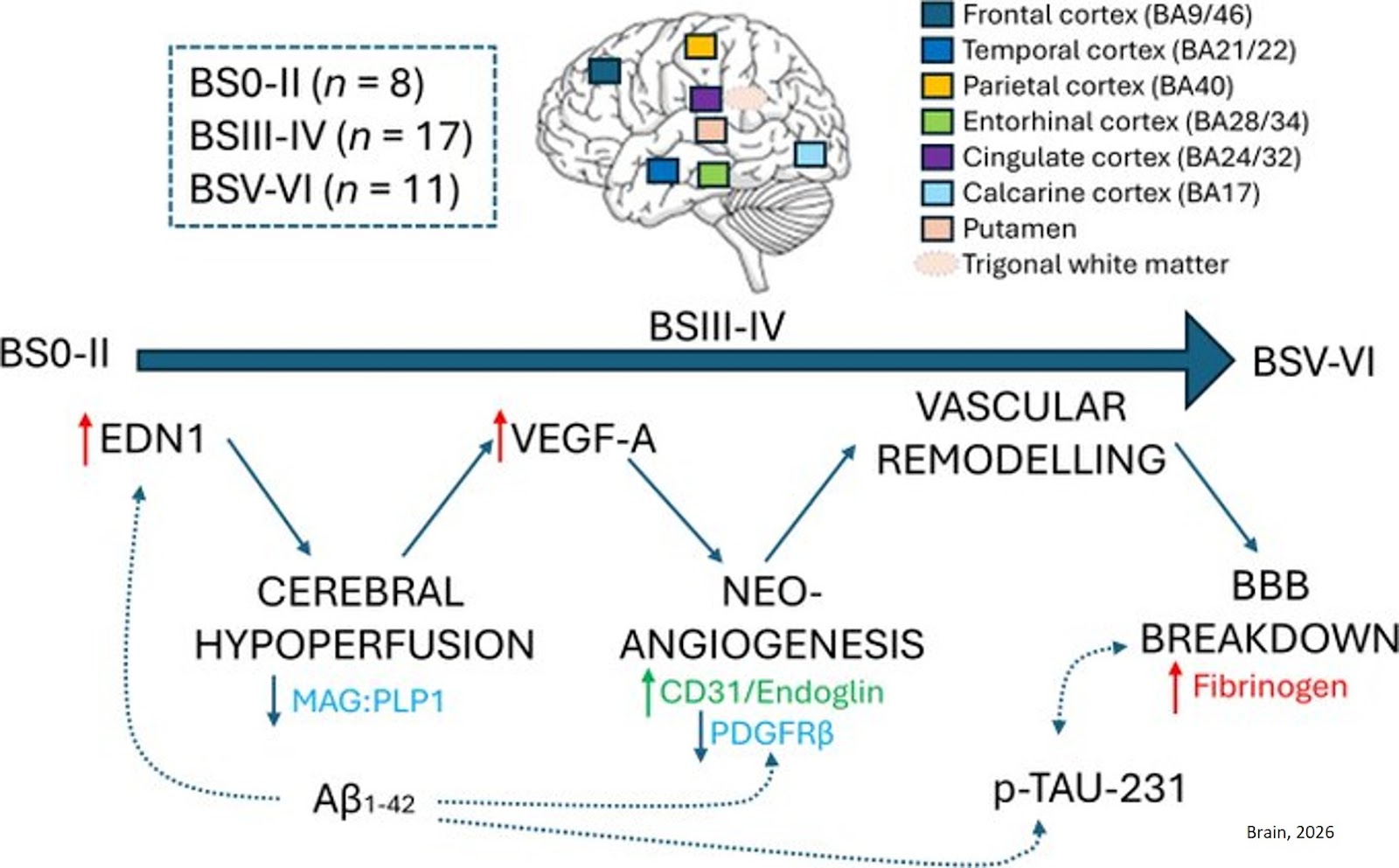Post-mortem evidence of pathogenic angiogenesis and abnormal vascular function in early Alzheimer’s disease