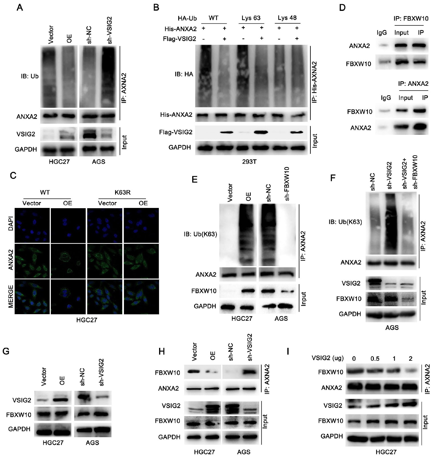 VSIG2 hinders gastric cancer progression by suppressing ANXA2-mediated NF-κB pathway activation
