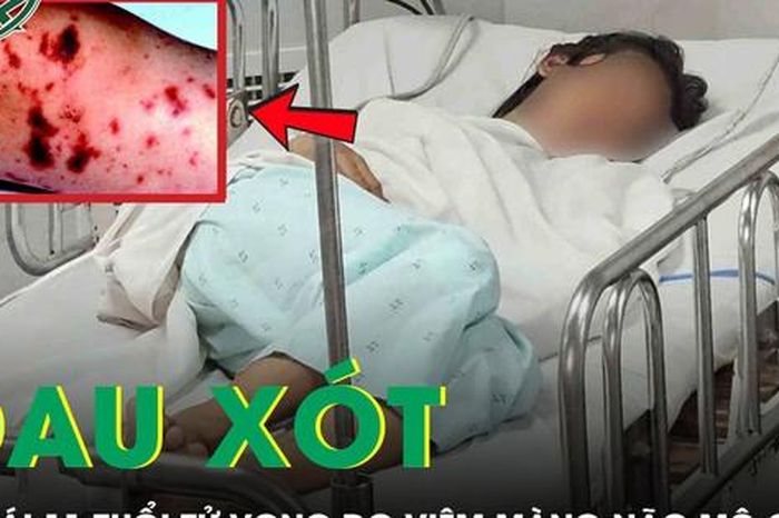 Đau xót: Bé gái 11 tuổi tử vong do viêm màng não mô cầu thể tối cấp - Báo Sức Khỏe &amp; Đời Sống