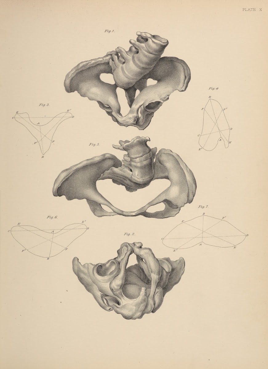 Malformation of the Pelvis 1885