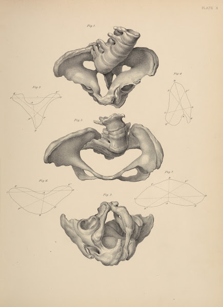 Malformation of the Pelvis 1885