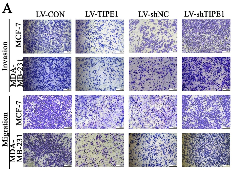TIPE1 suppresses the invasion and migration of breast cancer cells and inhibits epithelial-to-mesenchymal transition primarily via the ERK signaling pathway