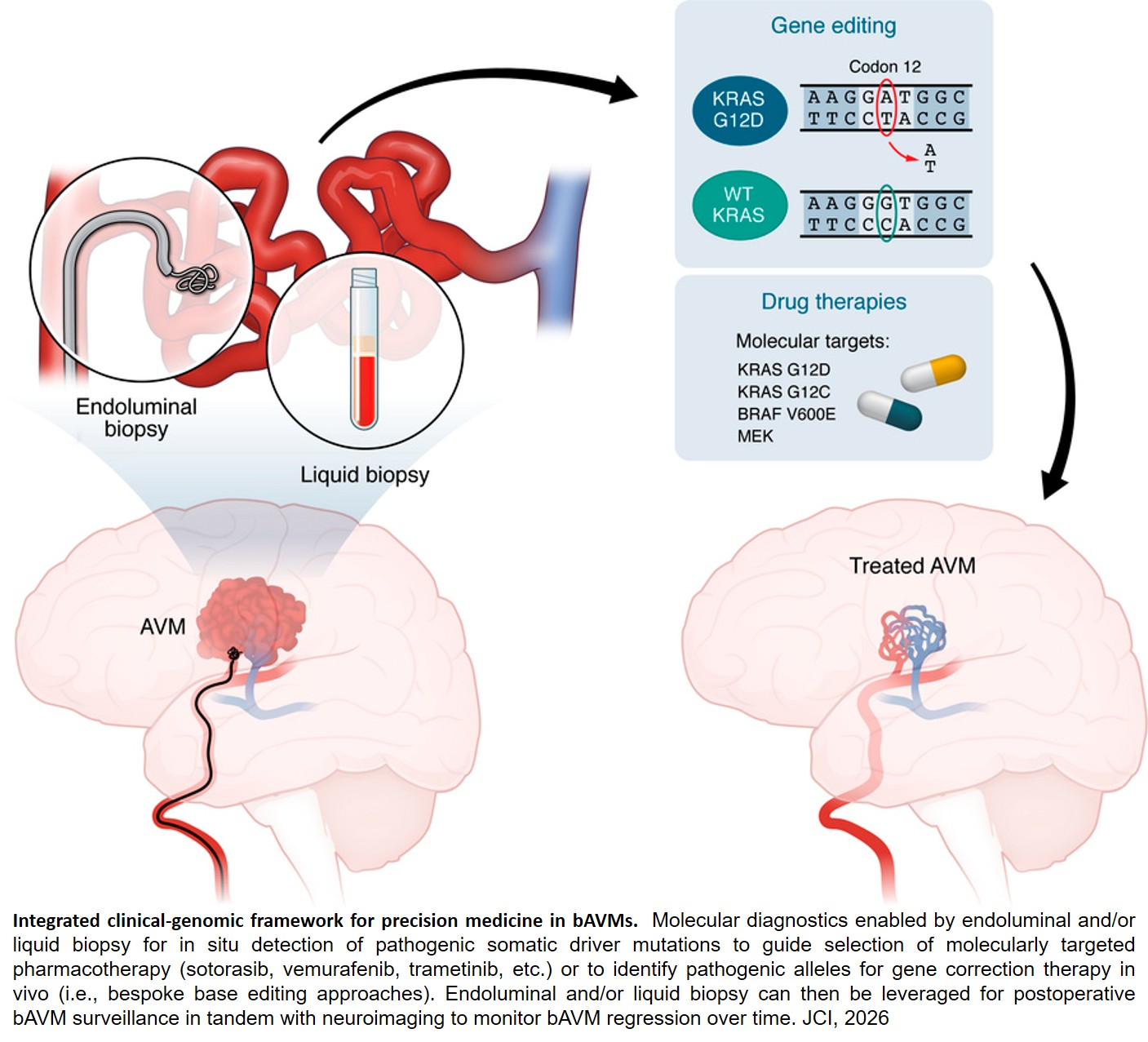 Precision medicine for brain arteriovenous malformations