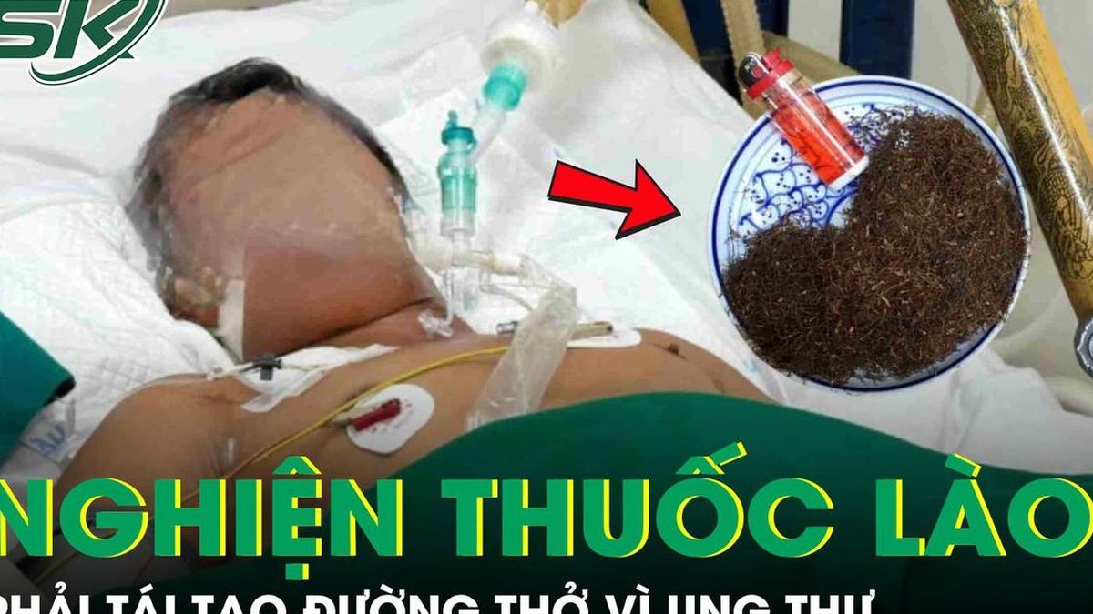 Người đàn ông phải tái tạo đường thở vì ung thư sau 30 năm nghiện thuốc lào - Báo Sức Khỏe &amp; Đời Sống