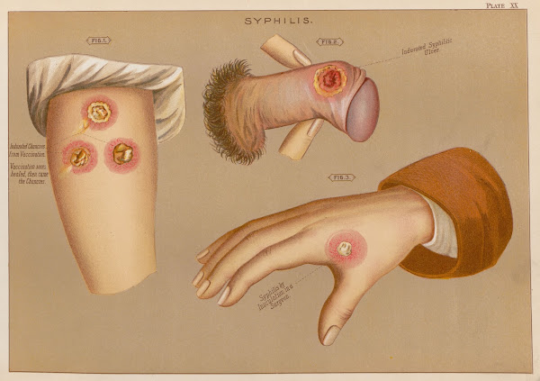 Syphilis 1889