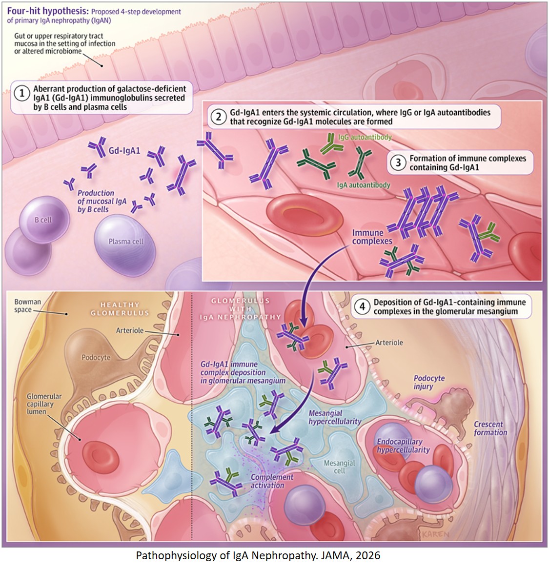 IgA Nephropathy in Adults