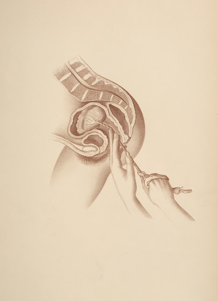 After birth by the Cord 1885