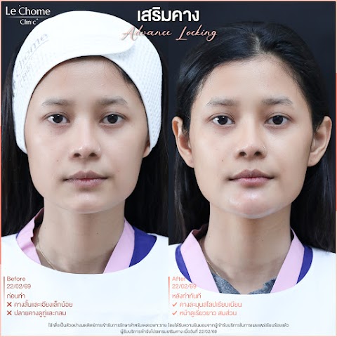 เสริมคาง