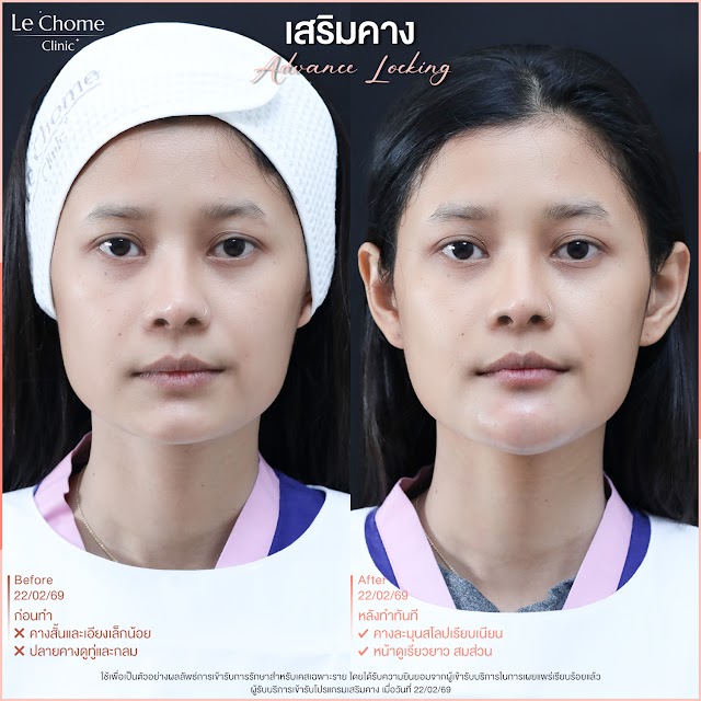 รีวิวเสริมคาง — เสริมคาง